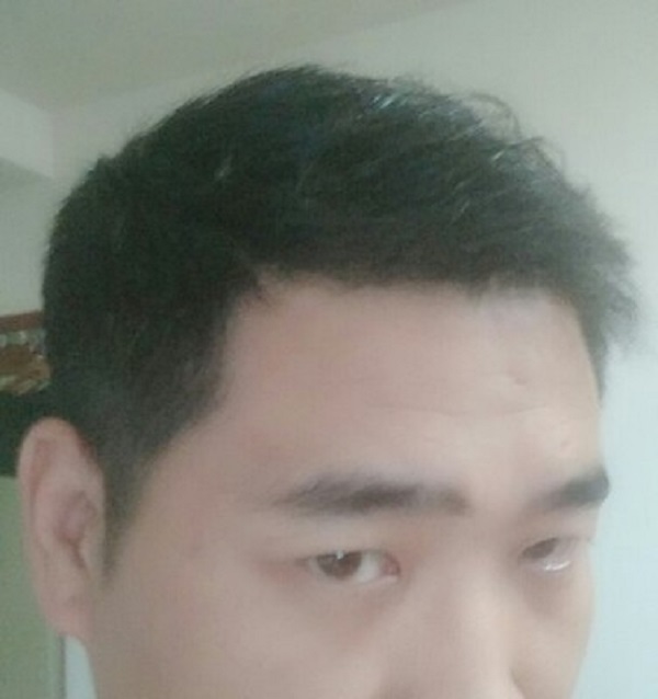 失去的不是頭發(fā)，是自信