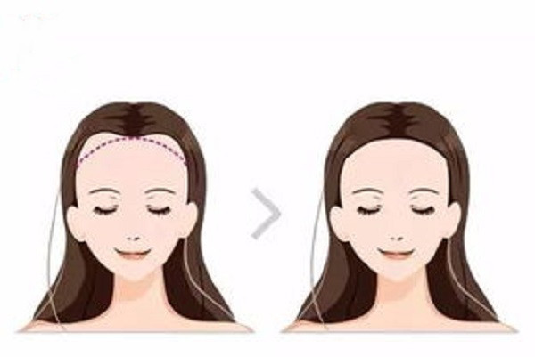 發(fā)際線植發(fā)會(huì)有危險(xiǎn)嗎