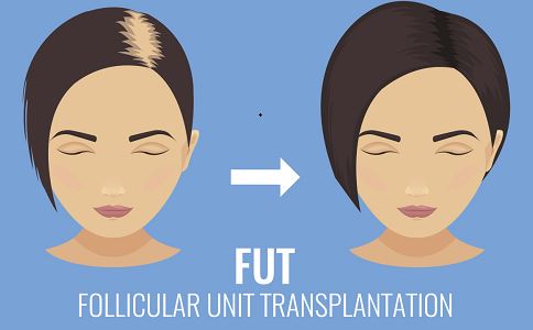 影響植發(fā)價(jià)格的都有什么因素