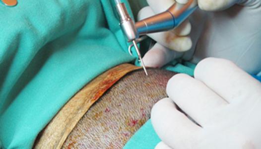 植發(fā)會造成的危害有哪些