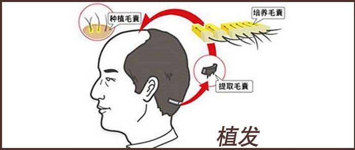 植發(fā)價(jià)格和什么因素有關(guān)系