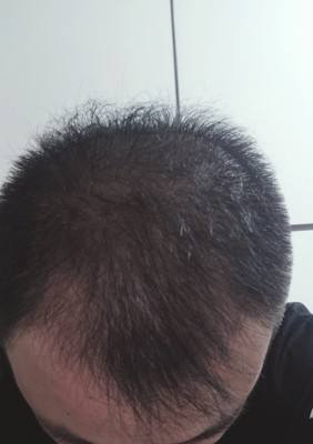 頭發(fā)纖維粉幫我增強自信