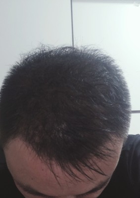 頭發(fā)纖維粉幫我增強自信