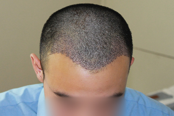 植發(fā)技術(shù)