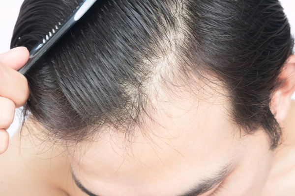 植發(fā)技術(shù)