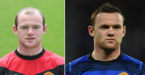 前額植發(fā)效果怎么樣|需要剃光頭嗎