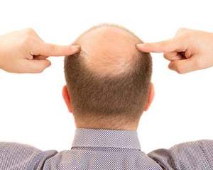 怎么確定脂溢性脫發(fā)