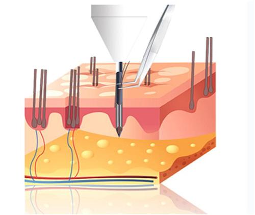 ZTC植發(fā)技術(shù)怎么樣