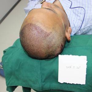 植發(fā)技術(shù)