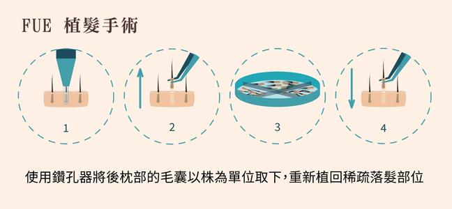 植發(fā)中的FUE和FUT有什么區(qū)別