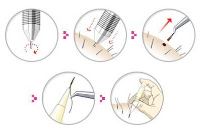 植發(fā)中的FUE和FUT有什么區(qū)別