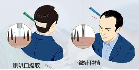 植發(fā)的技術(shù)有哪些