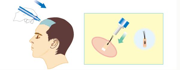 植發(fā)手術(shù)的危害有多大