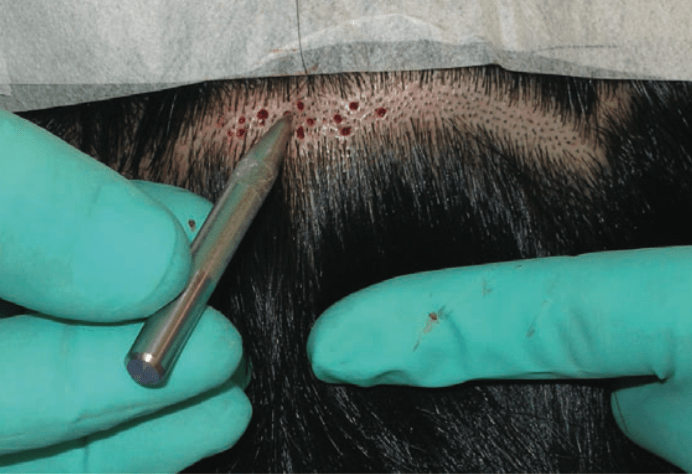 fue植發(fā)適合哪些人