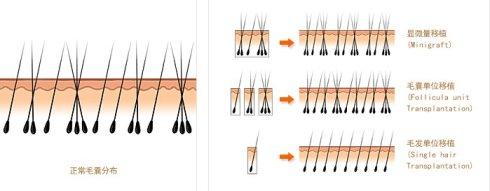 fue植發(fā)適合哪些人