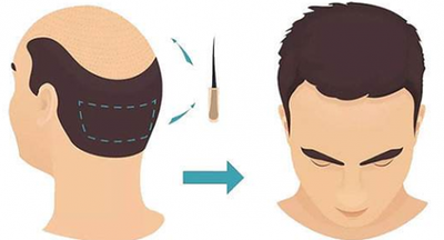 植發(fā)技術(shù)