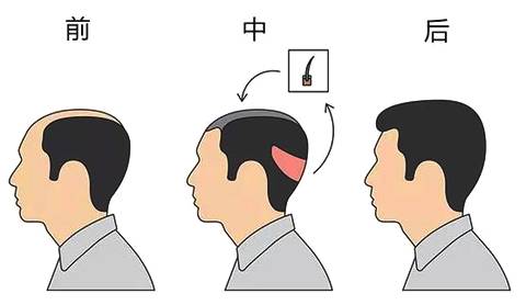 現(xiàn)在植發(fā)技術成熟了嗎