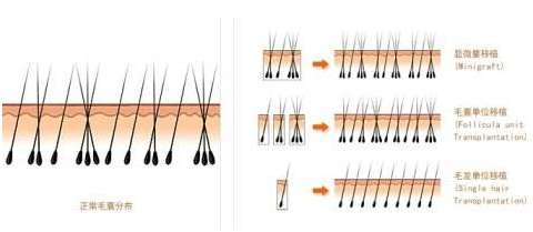 FUE植發(fā)是用的微針還是寶石刀