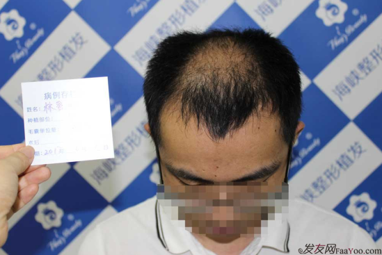 濟(jì)南植發(fā)案例3500單位效果完美，來看我的植發(fā)日記