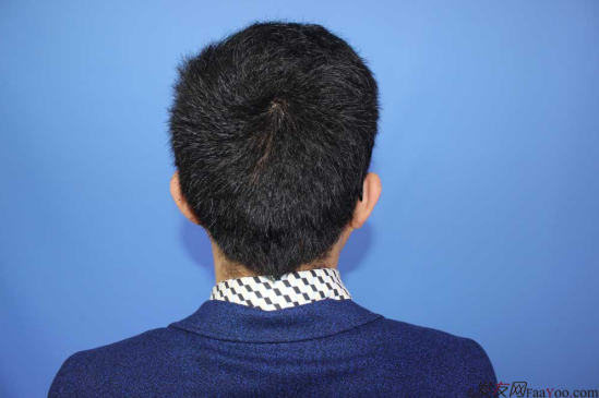 濟(jì)南植發(fā)案例3500單位效果完美，來看我的植發(fā)日記