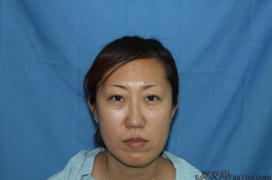 南加高紅俠主任眉毛種植術(shù)后一年效果植眉案例