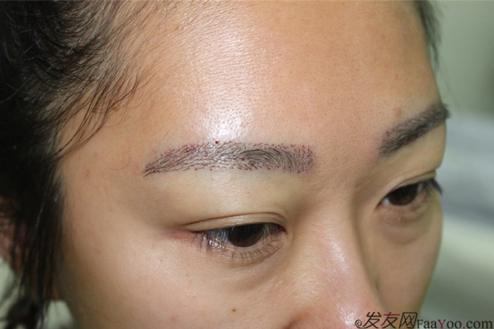 南加高紅俠主任眉毛種植術(shù)后一年效果植眉案例