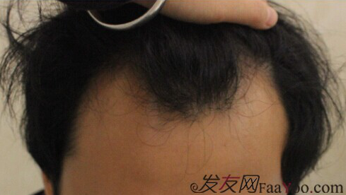 西安大麥微針2800單位慢慢看我蛻變