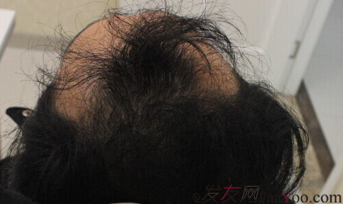 西安大麥微針2800單位慢慢看我蛻變