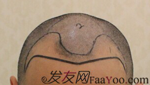 西安大麥微針2800單位慢慢看我蛻變