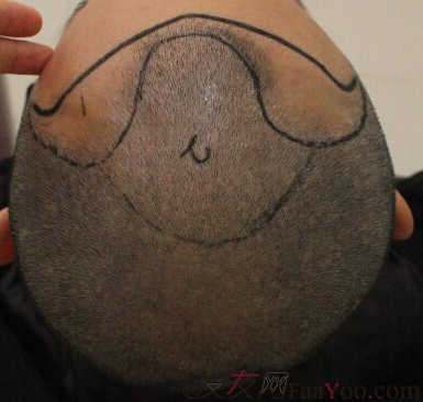 西安大麥微針2800單位慢慢看我蛻變