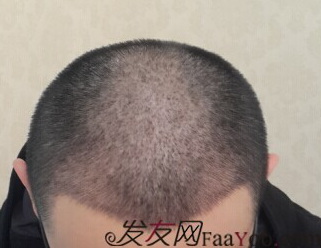 西安大麥微針2800單位慢慢看我蛻變