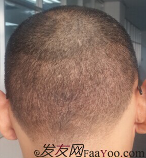 西安大麥微針2800單位慢慢看我蛻變