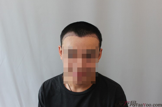 天津新發(fā)現(xiàn)植發(fā)1500單位，組團5折植發(fā)好醫(yī)生活動