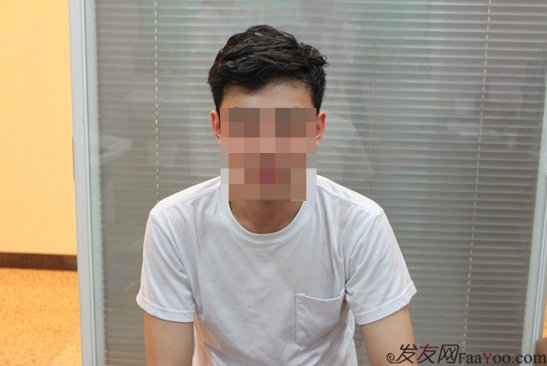 天津新發(fā)現(xiàn)植發(fā)1500單位，組團5折植發(fā)好醫(yī)生活動