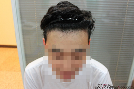 天津新發(fā)現(xiàn)植發(fā)1500單位，組團5折植發(fā)好醫(yī)生活動