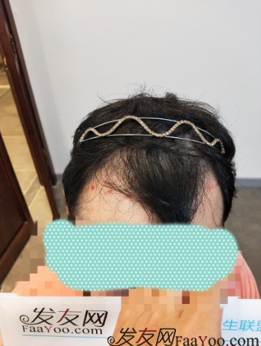 植發(fā)好醫(yī)生：沈陽牛大夫植發(fā)讓我做了一直想做的事情