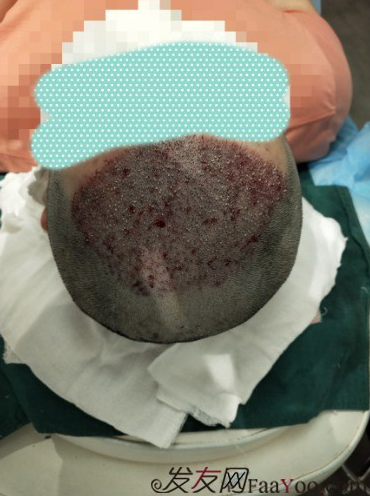 植發(fā)好醫(yī)生：沈陽牛大夫植發(fā)讓我做了一直想做的事情