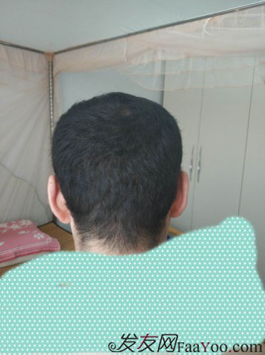 植發(fā)好醫(yī)生：沈陽牛大夫植發(fā)讓我做了一直想做的事情