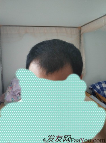 植發(fā)好醫(yī)生：沈陽牛大夫植發(fā)讓我做了一直想做的事情