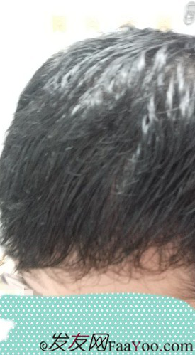 植發(fā)好醫(yī)生：沈陽牛大夫植發(fā)讓我做了一直想做的事情