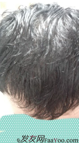 植發(fā)好醫(yī)生：沈陽牛大夫植發(fā)讓我做了一直想做的事情