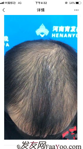 我在河南植了發(fā)，頭頂加密3000單位&nbsp;