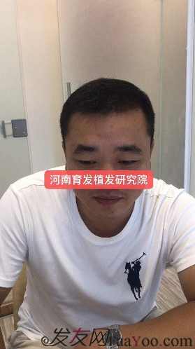 我在河南植了發(fā)，頭頂加密3000單位&nbsp;