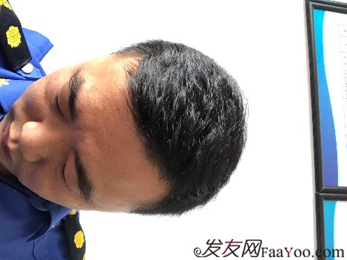 我在河南植了發(fā)，頭頂加密3000單位&nbsp;