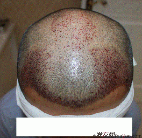 西安大麥微針FUE植發(fā)2100單位，一起等待效果