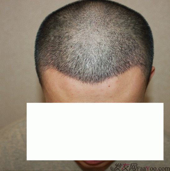 西安大麥微針FUE植發(fā)2100單位，一起等待效果