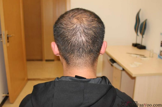 這世界還很美！感謝南寧大麥微針植發(fā)2860單位