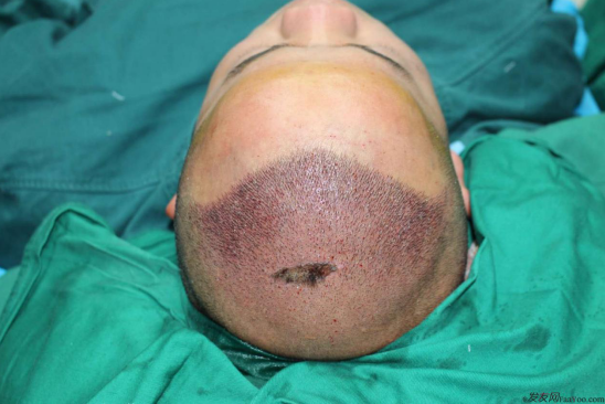 這世界還很美！感謝南寧大麥微針植發(fā)2860單位