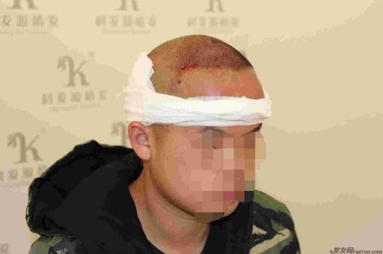 這世界還很美！感謝南寧大麥微針植發(fā)2860單位