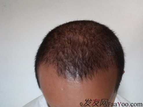 這世界還很美！感謝南寧大麥微針植發(fā)2860單位